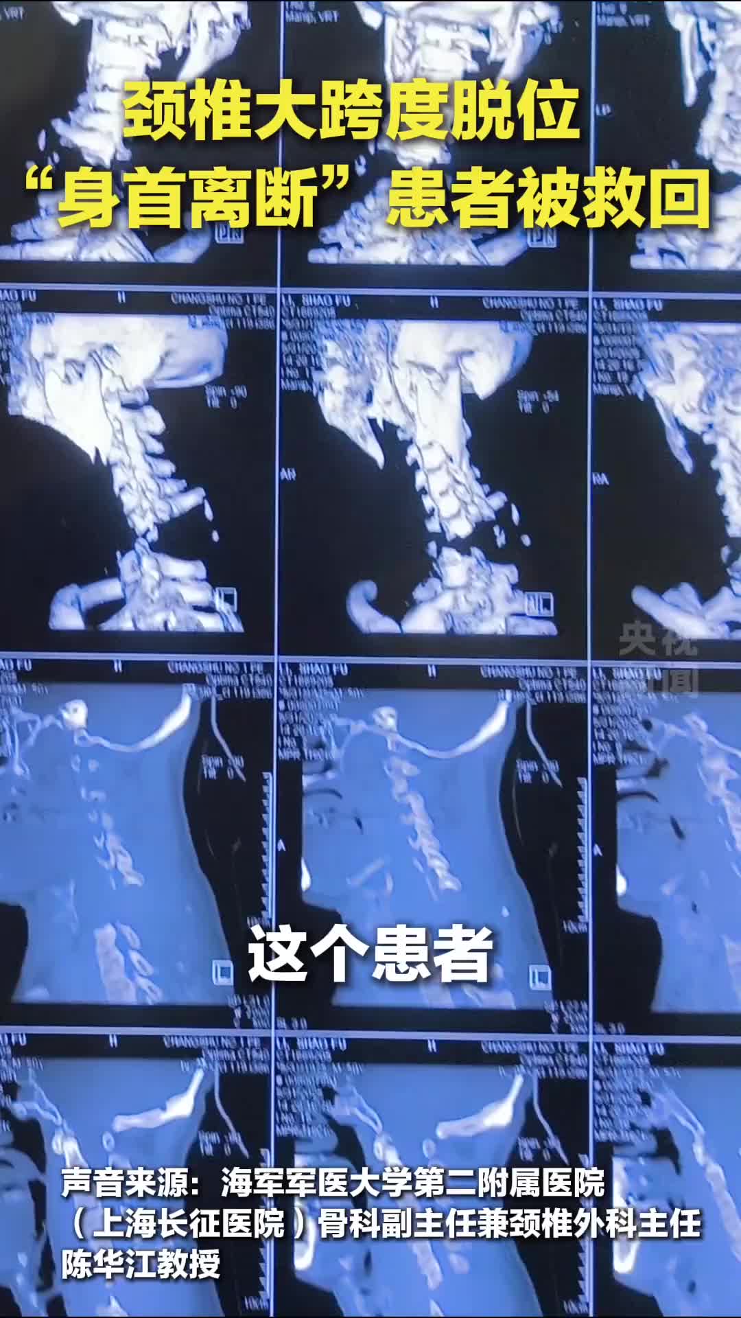 頸椎大跨度脫位 “身首離斷”患者被救回