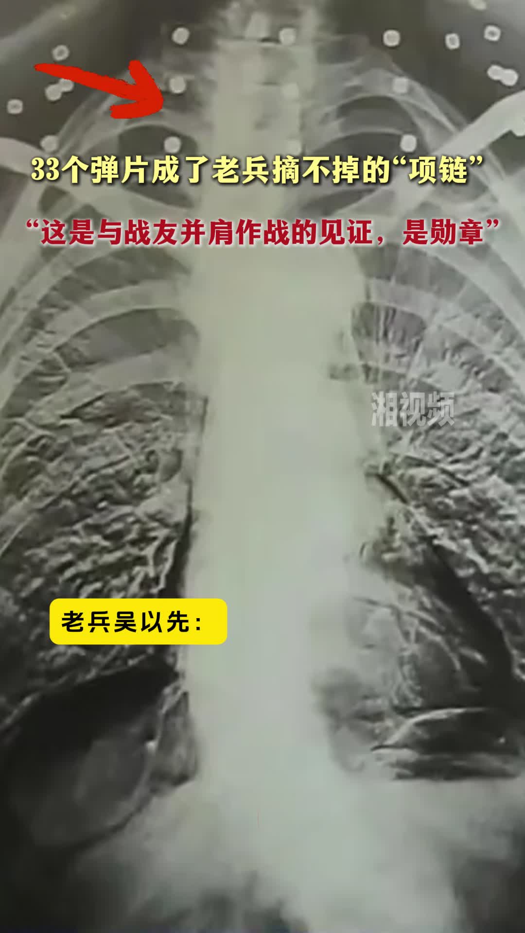 33个弹片成了老兵摘不掉的“项链”