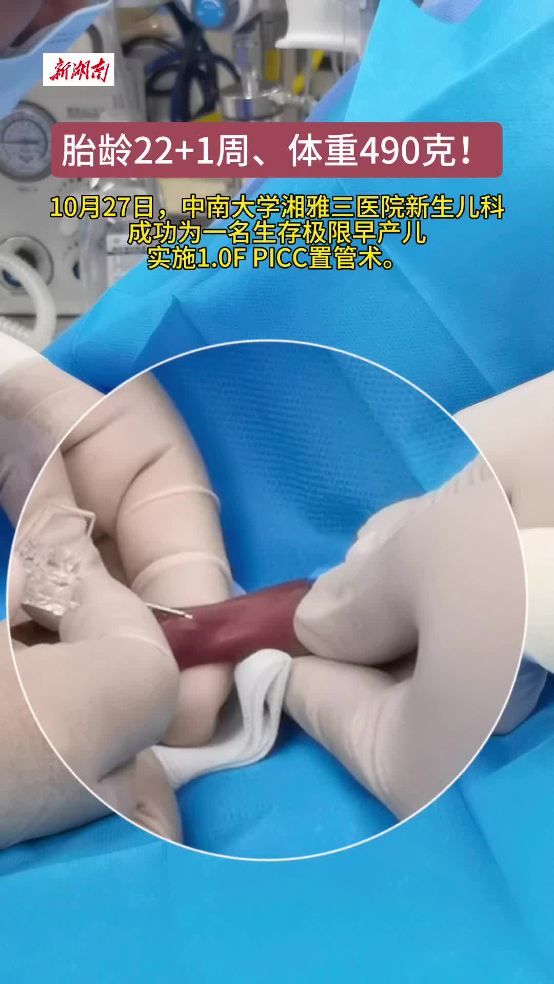 直击|为胎龄22+1周超早产儿打通“生命通道”