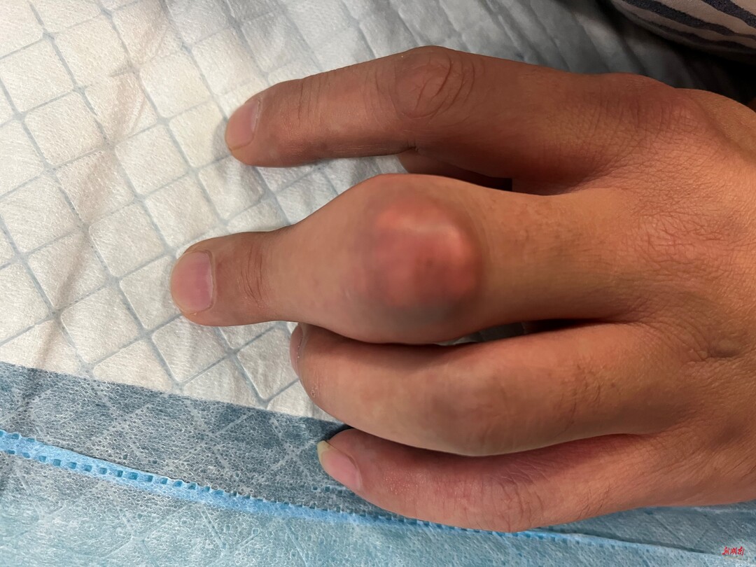 管不住嘴,手指竟长出"石头"?-新湖南