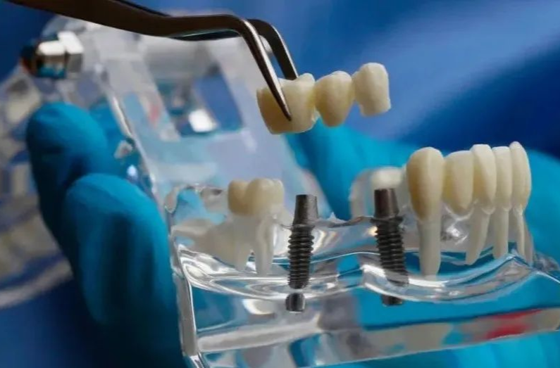 好消息，长沙市口腔医院同步落实种植牙全流程医疗服务价格调控！手术价格平均下降3000到5000元