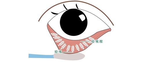 株洲爱尔眼科医院:睑板腺堵塞是导致干眼症的隐形杀手 