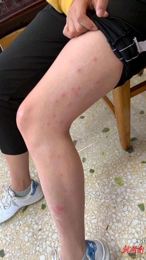 夏季露营好时节 专家：做好这几点预防虫咬皮炎