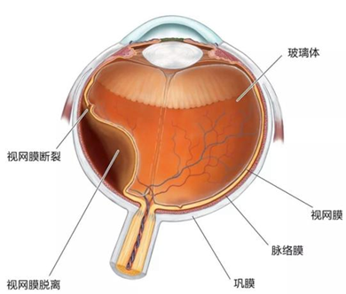 高度近视引起视网膜脱离，还能做近视手术吗？