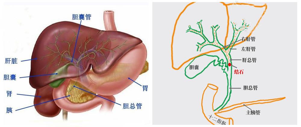 常德一医普外科取胆总管结石手术更微创 让患者免受