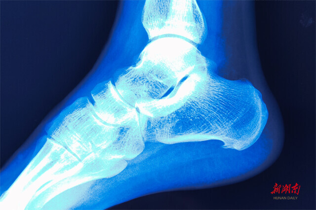 一天不跑10公里就难受？警惕这种病