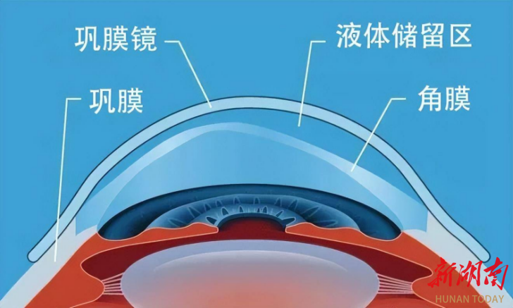 湖南省首例巩膜镜在长沙爱尔眼科医院成功验配 