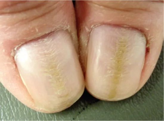 指甲月牙小,有竖纹,就是不健康?错!