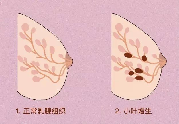 月经前女性感到乳房胀痛,这是正常的生理性乳腺增生,不能算病.