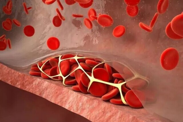 长期久坐，当心这个“沉默的杀手”