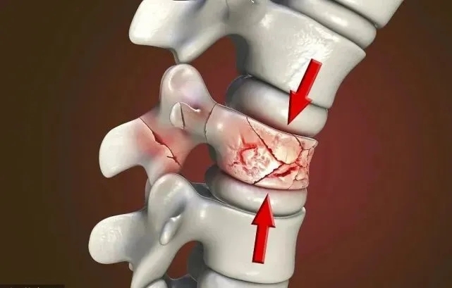 脊柱外科副主任醫師蓋景穎解釋,腰椎壓縮性骨折是腰椎椎體在經受暴力