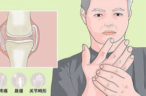 防治类风湿关节炎  祛除“湿热毒痹”是关键