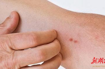 冬季皮肤瘙痒，不能一抓了之