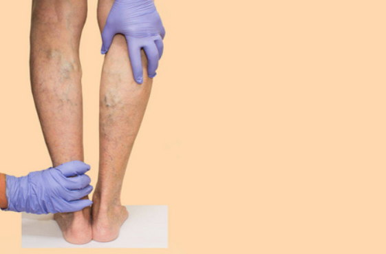 女子下肢水肿迈不开腿 “光腿神器”竟成罪魁祸首？