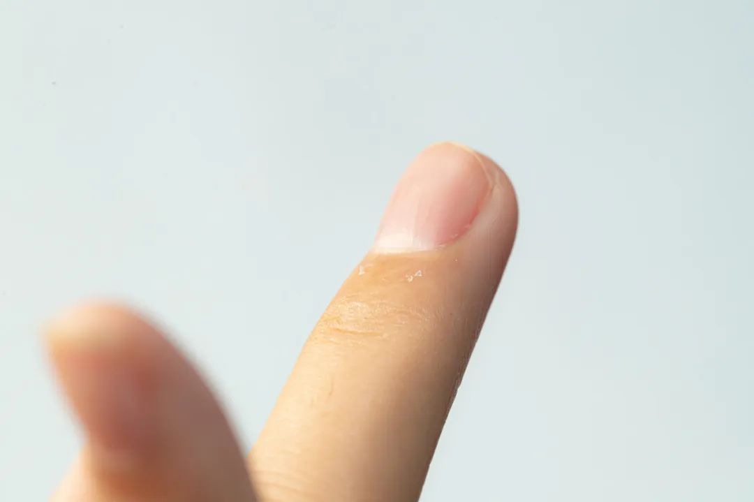 疼疼疼!手上倒刺反复长，真不是缺维生素，而是.....