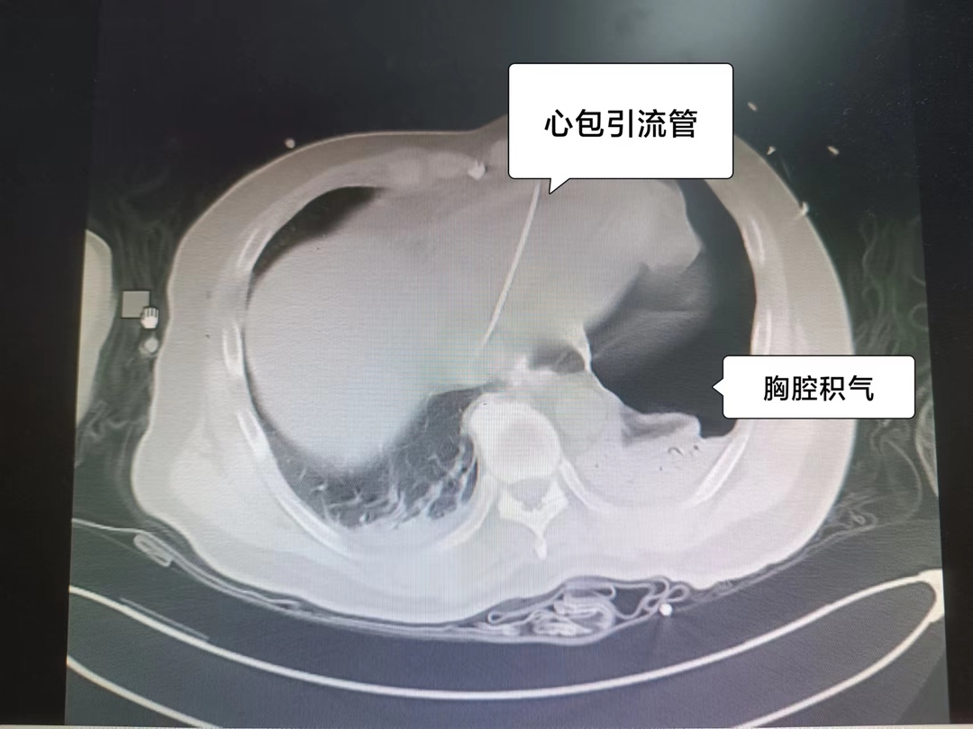 據介紹,心包填塞是外傷性心臟破裂或心包內血管損傷造成心包腔內血液