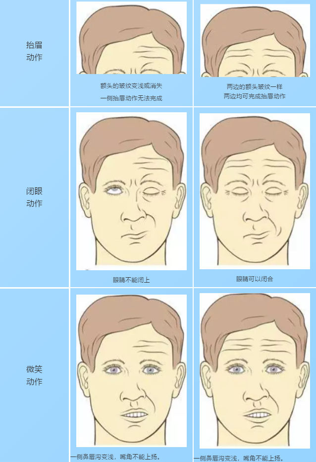 年轻小伙突然面瘫中医对症一针见效