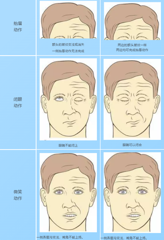 年轻小伙突然面瘫,中医对症"一针"见效