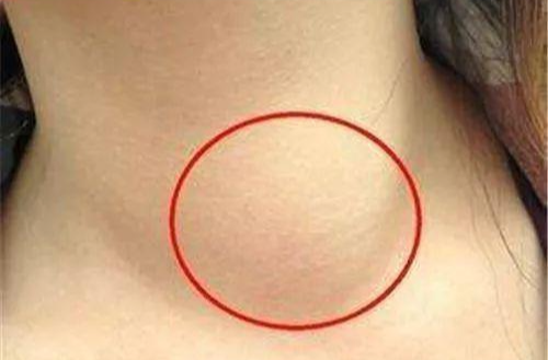 为什么甲状腺疾病盯上年轻人