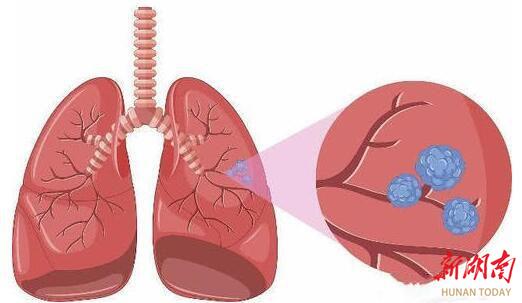 如何科学认识肺部结节？