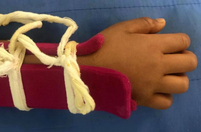 郴州市中医医院：13岁男孩左臂骨折无需开刀 中医正骨手法复位助力康复
