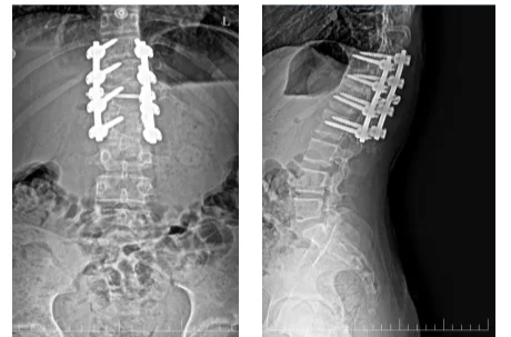 脊柱矫形手术，12岁脊柱侧弯少年增高8厘米