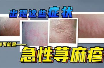 关于麻疹，这些知识您要掌握