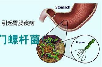 关于“幽门螺杆菌”的基本知识，看完这篇就懂了